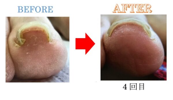 しっかり親指を使って歩けるようになり、膝や股関節痛も楽になりました！