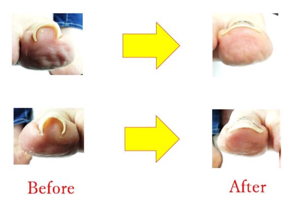 もう巻き爪再発させたくない方は、ここが一番です！