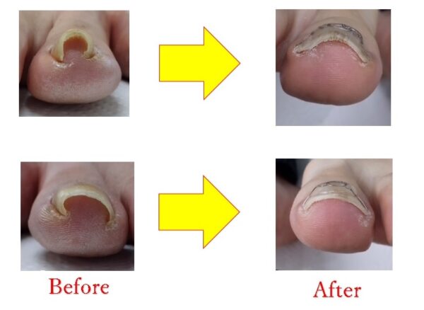 学生のころからの悩んでいた爪が改善しました！