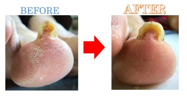 病院で矯正するも1年で再発、歩けない程の痛みが消失（初回）