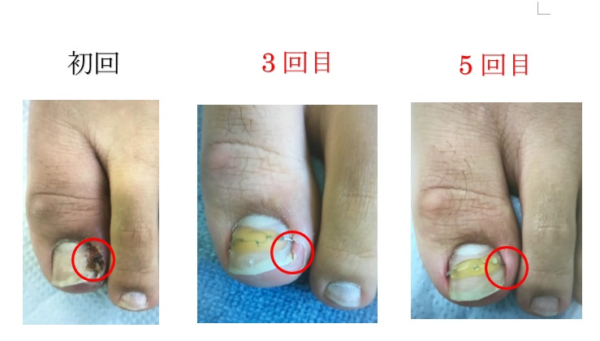 出血、痛みなど再発を繰り返していたのに、今までの苦労は何だったの