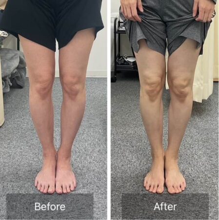 O脚ビフォーアフター